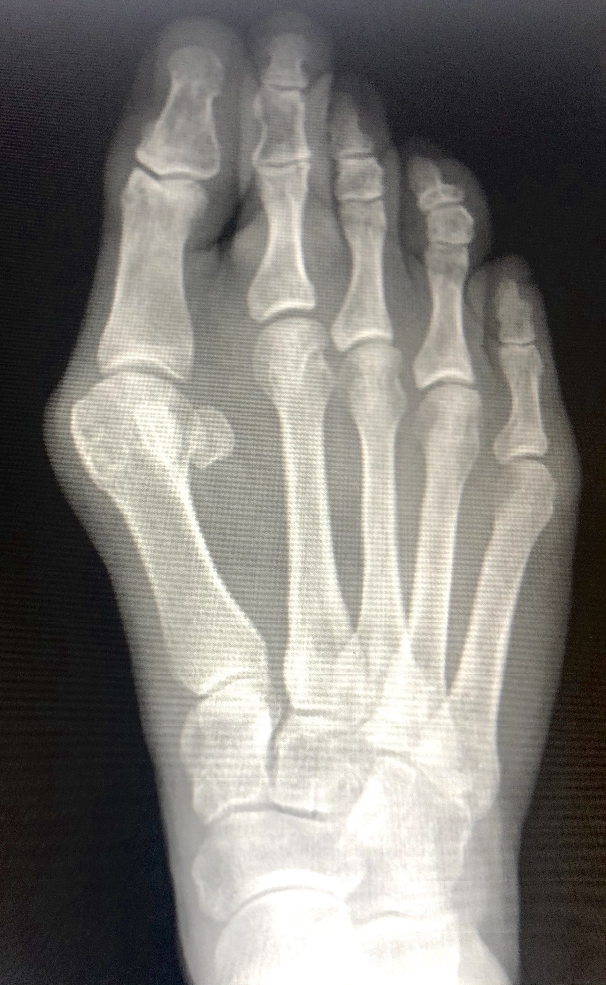 Lapiplasty: A Cutting-Edge Bunion Procedure with Dr. Dujela at