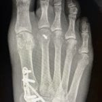 traditional modified lapidus bunion technique